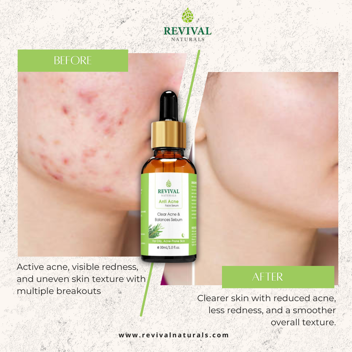 Anti-Acne Face Serum (Clear Skin)