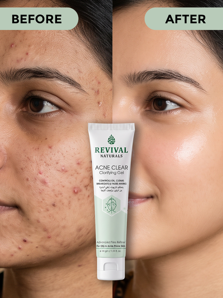 Acne Clear Gel